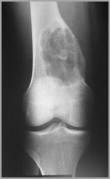 Bone Tumors